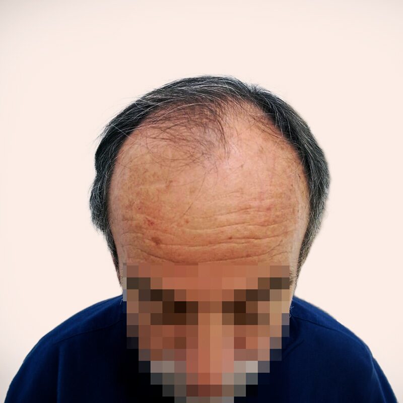 Paciente antes — alopecia frontal extendida