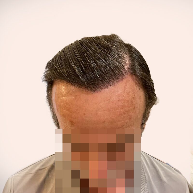 Paciente después — frontal con densidad y línea natural