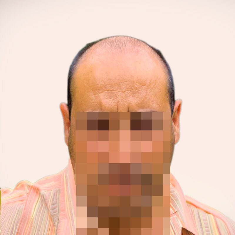 Paciente antes — alopecia avanzada