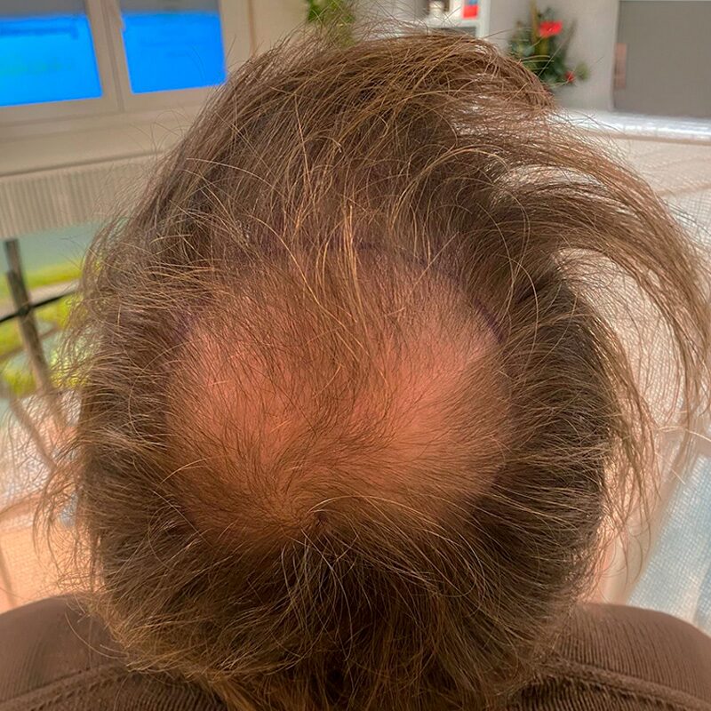 Antes — alopecia marcada en coronilla