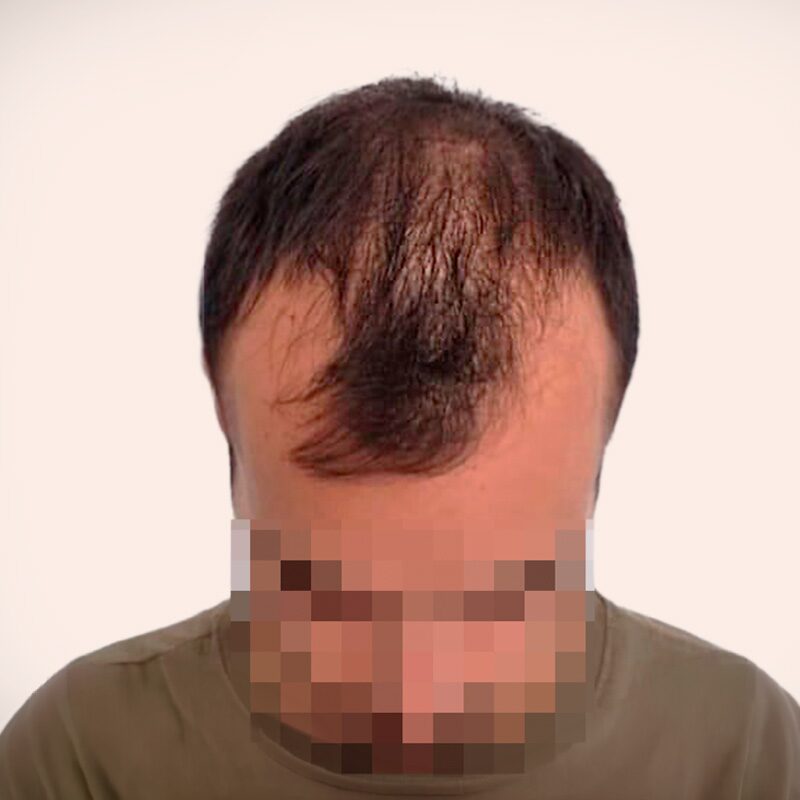 Paciente antes de la cirugía — alopecia frontal con entradas marcadas