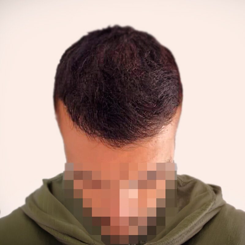 Paciente a 6 meses post-cirugía — frontal poblado y línea natural