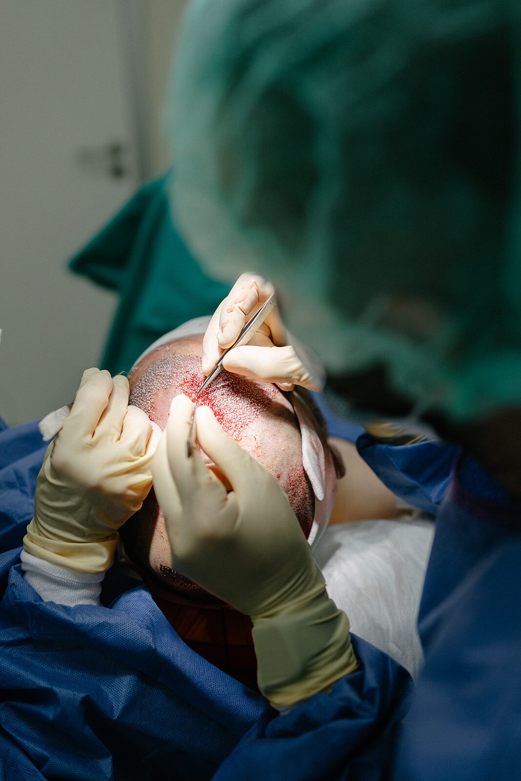 Detalle de implantación folicular en quirófano durante una cirugía capilar FUE
