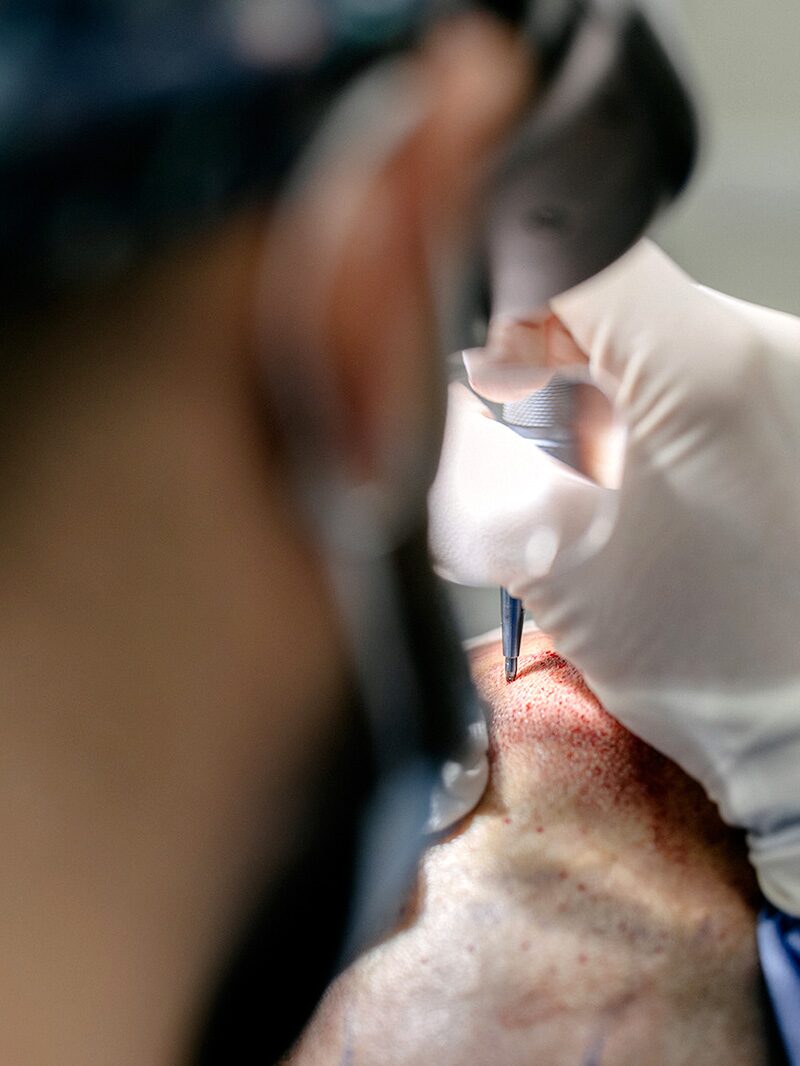 Implante folicular con micropunción